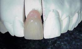 Zirkonkrone mit Zahnfleisch Keramik